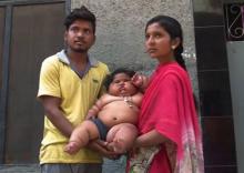 Chahat Kumar, une petite fille de 8 mois qui pèse 17 kilos. Inde.