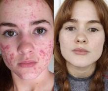 Une jeune femme avec de l'acné.