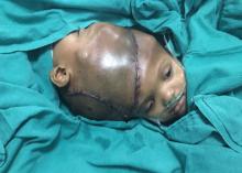 Deux frères siamois reliés par la tête ont été séparés après 36 heures d'opérations chirurgicales. C