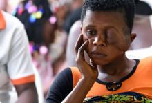 Flora Doumé, une jeune femme souffrant de la maladie du noma qui l'a défigurée, attend d'être opérée