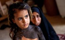 Haoura, une fillette irakienne de quatre ans, souffre d'une rare maladie de peau qui couvre une partie de son corps d'une large tache noire recouverte de poils. A Wahed Haziran, le 17 avril 2018