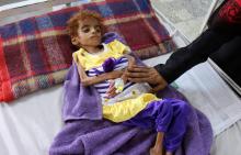 Un enfant souffrant de malnutrition est hospitalisé dans la province yéménite de Hajjah (nord-ouest), le 8 septembre 2018