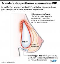 Scandale des prothèses mammaires PIP