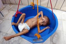 Un enfant souffrant de malnutrition est pesé dans un hôpital du nord-ouest du Yémen, le 7 novembre