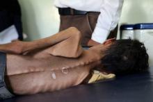Ghazi Ali ben Ali, un Yéménite de 10 ans qui souffre de malnutrition aigüe, est allongé sur un lit le 30 octobre 2018 dans un hôpital de Jabal Habashi près de la ville de Taëz, dans le sud du Yémen