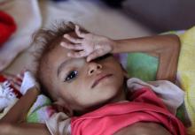 Un enfant yéménite souffrant de malnutrition. Photo prise le 6 octobre 2018 dans un hôpital de Sanaa