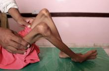 Un enfant yéménite souffrant de malnutrition reçoit des soins dans un hôpital de la province d'Al Hajjah, dans l'ouest du Yémen, le 25 octobre 2018