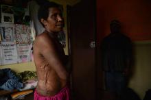 Rachel, une mère de deux enfants, montre le 20 novembre 2018 à son domicile dans la Vallée de Tsak, en Papouasie Nouvelle Guinée, les cicatrices des tortures reçues par des villageois qui l'accusaient
